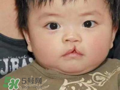 兔唇可以治嗎？兔唇修補術