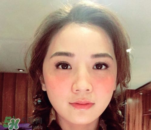 夏天可以點痣嗎？夏天點痣后要注意什么？