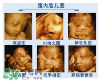 四維彩超有必要做嗎？四維彩超檢查不出什么？