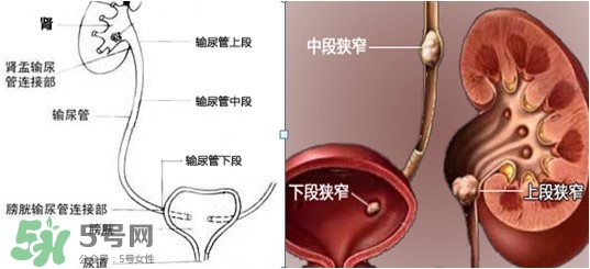 腎結(jié)石怎么治最好？腎結(jié)石的醫(yī)治方法