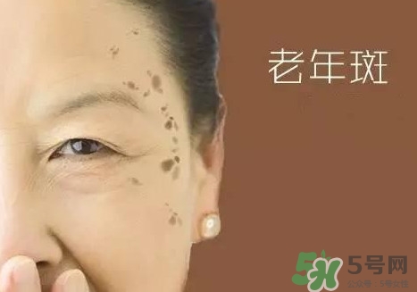 老年斑多大年齡開始有？為什么牙膏能去老年斑？
