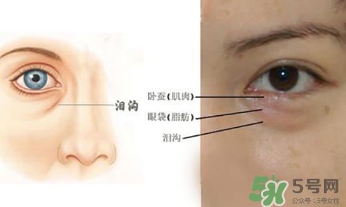 淚溝能自己恢復(fù)嗎？淚溝怎么自己恢復(fù)？