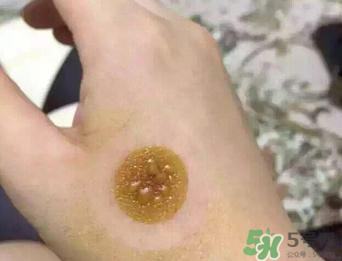 艾灸貼后有水泡怎么辦？貼艾灸貼應注意些什么？
