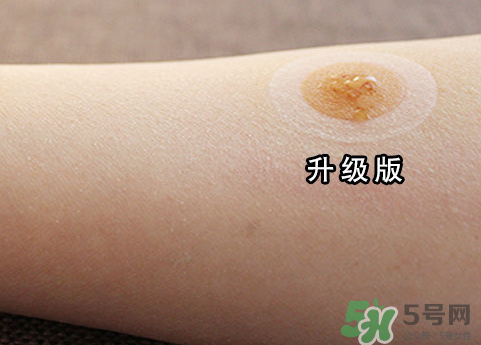 艾灸貼后有水泡怎么辦？貼艾灸貼應注意些什么？