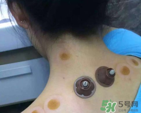 艾灸貼后有水泡怎么辦？貼艾灸貼應注意些什么？