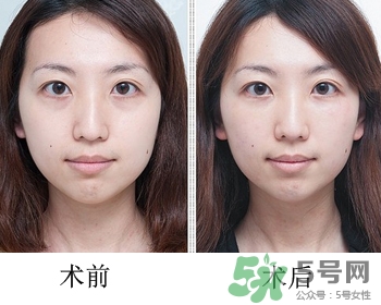 填充淚溝有風險嗎？填充淚溝的方法