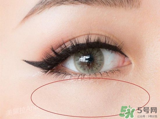 玻尿酸填充淚溝多久恢復自然？玻尿酸填充淚溝的危害