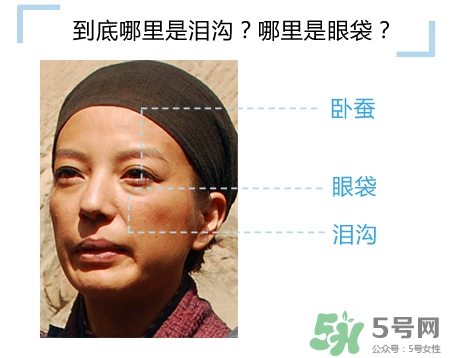玻尿酸填充淚溝多久恢復自然？玻尿酸填充淚溝的危害