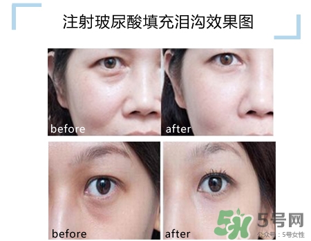 玻尿酸填充淚溝多久恢復自然？玻尿酸填充淚溝的危害