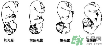胎位不正能順產(chǎn)嗎？胎位不正怎么辦？