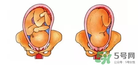 胎位不正能順產(chǎn)嗎？胎位不正怎么辦？