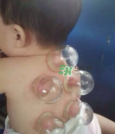拔火罐后顏色多久消失？拔火罐印子多久能消除？