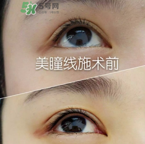 做美瞳線可以吃雞蛋嗎？做美瞳線能吃雞蛋嗎？