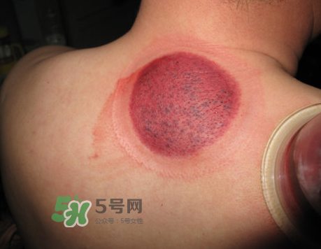 三伏天拔罐后多久可以洗澡？三伏天拔罐后注意事項