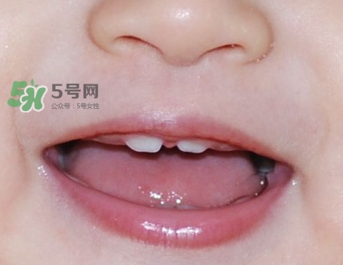 牙齒縫隙大怎么辦？牙縫大帶牙套有用嗎