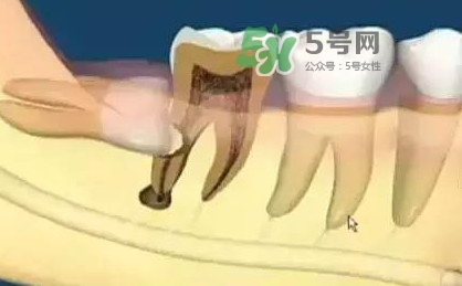 智齒是每個(gè)人都會(huì)長(zhǎng)嗎？拔智齒能瘦臉嗎？
