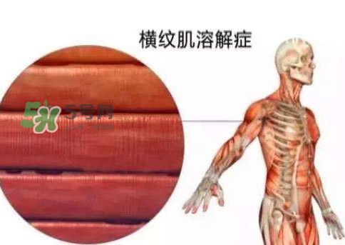 橫紋肌溶解癥會死亡嗎？橫紋肌溶解癥能活多久