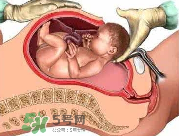 剖腹產(chǎn)比順產(chǎn)安全嗎？剖腹產(chǎn)產(chǎn)后注意事項(xiàng)？