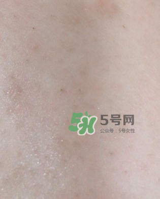 Dermatix舒痕疤痕膏有效嗎？Dermatix舒痕疤痕膏怎么用？