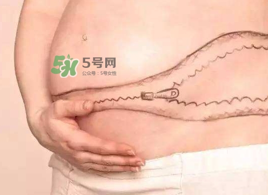 剖腹產(chǎn)疤痕怎么去除？剖腹產(chǎn)疤痕能去掉嗎？