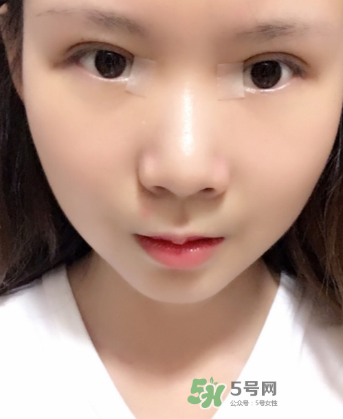 美皮護(hù)去疤效果怎么樣？美皮護(hù)有用嗎？