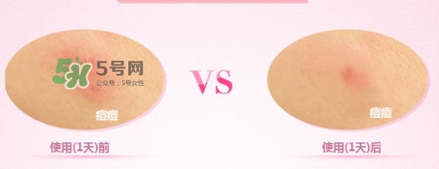 3m痘痘貼怎么用？3m痘痘貼貼多久？