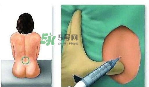 無痛分娩為什么不提倡？無痛分娩有后遺癥嗎？