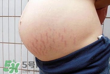 妊娠紋什么時候開始預防？妊娠紋什么時候消除？