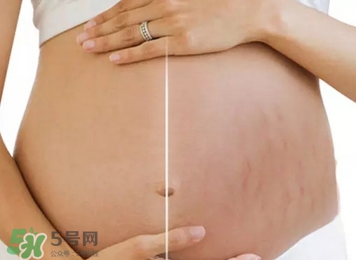 脖子上會長妊娠紋嗎？妊娠紋長在哪些地方？