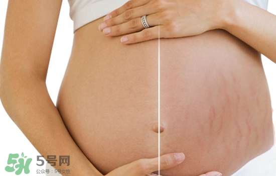 妊娠紋在左邊生男或女？怎么從妊娠紋看男女？