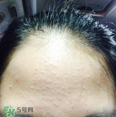 長痘長閉口怎么辦？長痘長閉口是什么原因？
