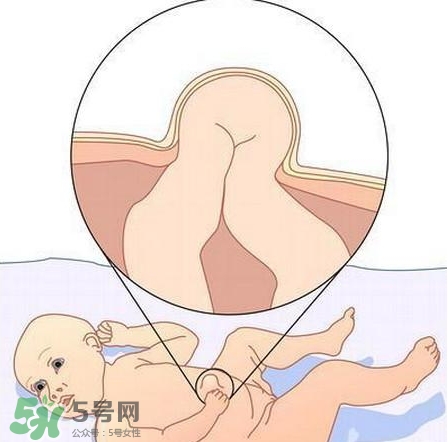 臍疝是什么？臍疝對寶寶有什么影響？