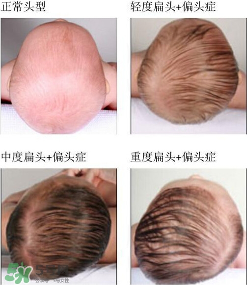 寶寶頭型是睡出來的嗎？寶寶頭型矯正最佳時間