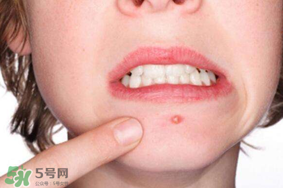 暗瘡可以擠壓?jiǎn)?？油性和骯臟肌膚會(huì)容易有暗瘡嗎？