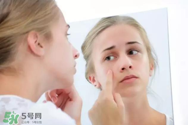 暗瘡可以擠壓?jiǎn)?？油性和骯臟肌膚會(huì)容易有暗瘡嗎？