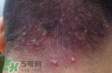 痤瘡和毛囊炎一樣嗎？痤瘡與毛囊炎區(qū)別