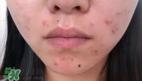 痤瘡和毛囊炎一樣嗎？痤瘡與毛囊炎區(qū)別