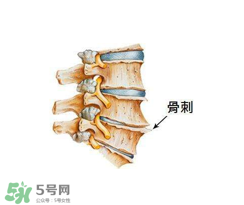 骨刺是怎么形成的？骨刺怎么治療？