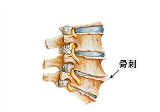 骨刺是怎么形成的？骨刺怎么治療？
