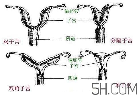 子宮畸形有哪些？子宮畸形有什么影響？