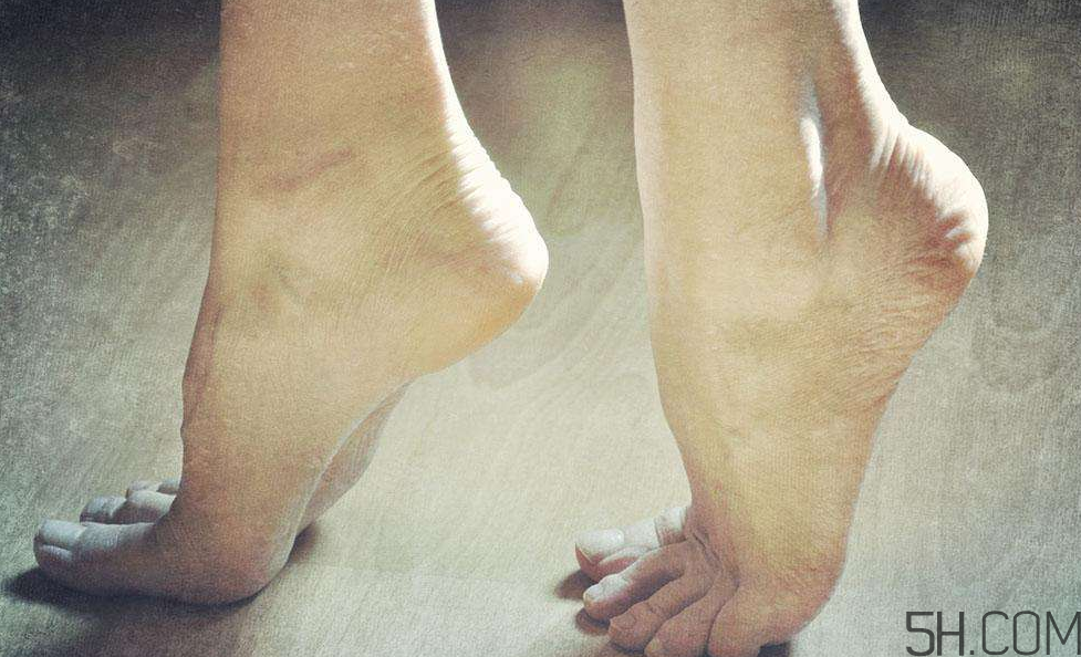 腳氣是什么原因引起的？腳氣是濕氣重引起的嗎?