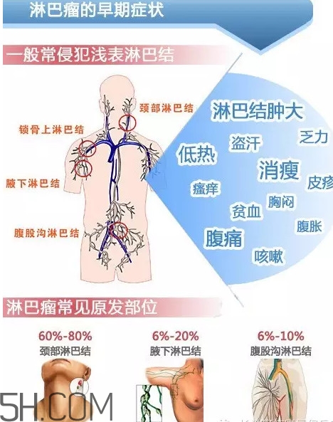 淋巴癌是怎么回事？淋巴癌如何診斷