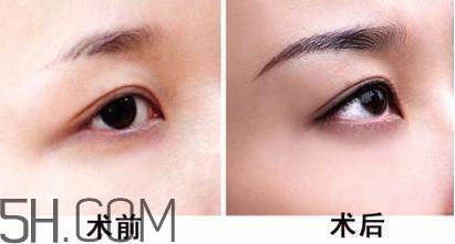 切眉手術(shù)后老得快嗎？切眉能保持多久？