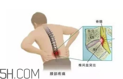 腰間盤突出是什么原因引起的？腰間盤突出是腎虛嗎