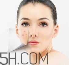 濕熱型痤瘡是什么？怎么調(diào)理濕熱型痤瘡？