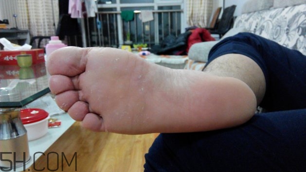 腳氣可以用酒精消毒嗎？腳氣可以用碘伏消毒嗎？