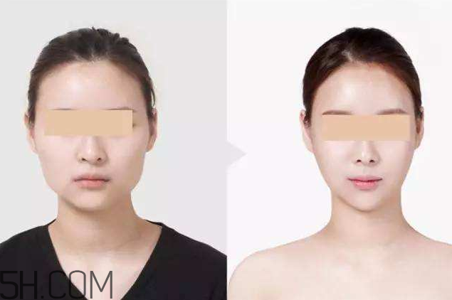 打瘦臉針可以抽煙嗎？打瘦臉針會(huì)反彈嗎？