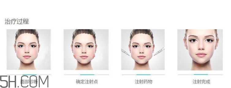 打瘦臉針可以抽煙嗎？打瘦臉針會(huì)反彈嗎？