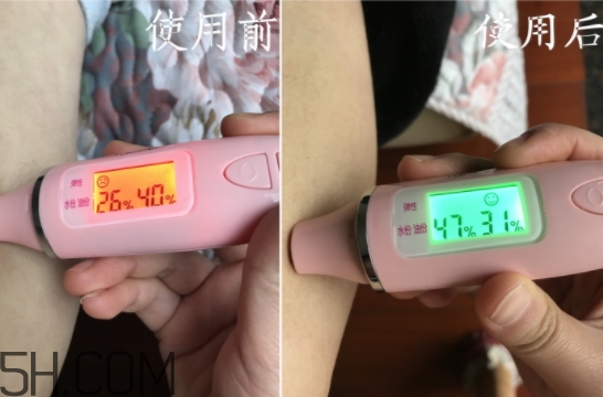 水楊酸可以去黑頭嗎？水楊酸可以去閉口嗎