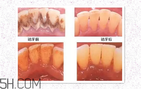 超聲波洗牙可以美白牙齒嗎？超聲波洗牙多少錢一次？